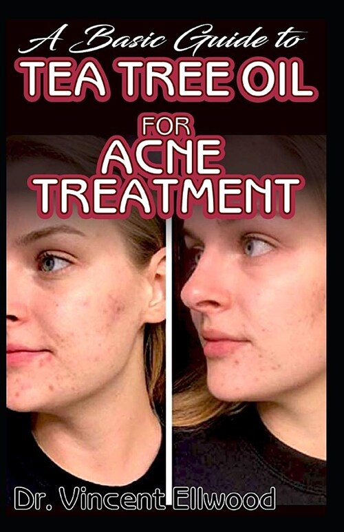 A Basic Guide To Tea Tree Oil for Acne Treatment: All you need to know about tea tree oil and how its the most potent natural treatment for clearing a (Paperback)