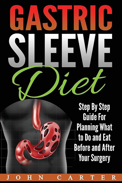 Gastric Sleeve Diet: Step By Step Guide For Planning What to Do and Eat Before and After Your Surgery (Paperback)