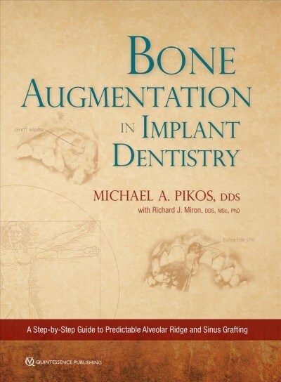 Bone Augmentation in Implant Dentistry: A Step-By-Step Guide to Predictable Alveolar Ridge and Sinus Grafting (Hardcover)