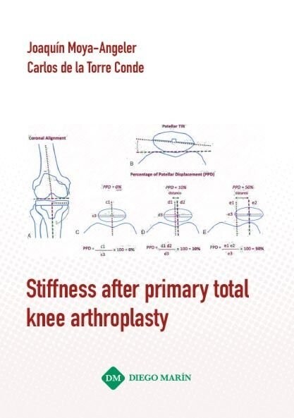 STIFFNESS AFTER PRIMARY TOTAL KNEE ARTHROPLASTY (Paperback)