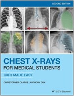 Chest X-Rays for Medical Students: Cxrs Made Easy (Paperback, 2)