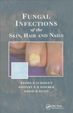 Fungal Infections of the Skin and Nails (Paperback)