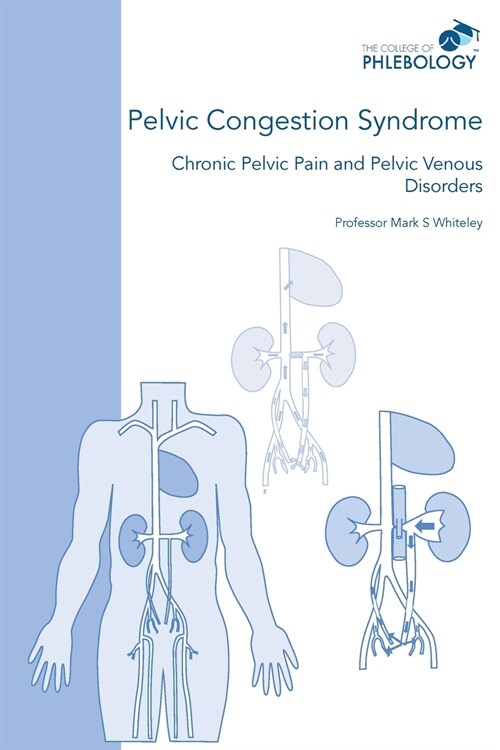 Pelvic Congestion Syndrome - Chronic Pelvic Pain and Pelvic Venous Disorders (Paperback)