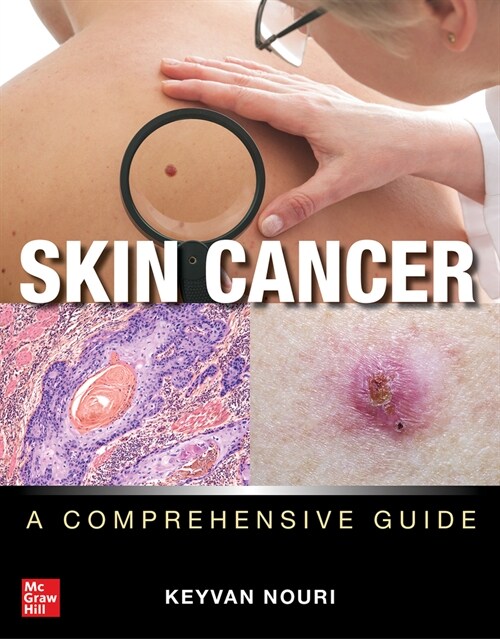 Skin Cancer: A Comprehensive Guide (Hardcover)