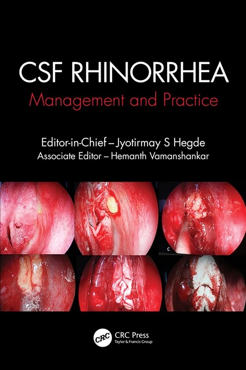 CSF Rhinorrhoea : Management and Practice (Paperback)