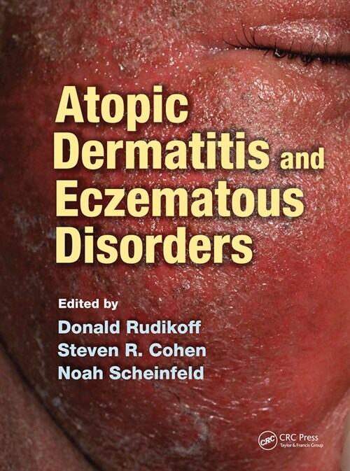 Atopic Dermatitis and Eczematous Disorders (Paperback, 1)