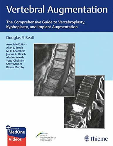 Vertebral Augmentation: The Comprehensive Guide to Vertebroplasty, Kyphoplasty, and Implant Augmentation (Hardcover)