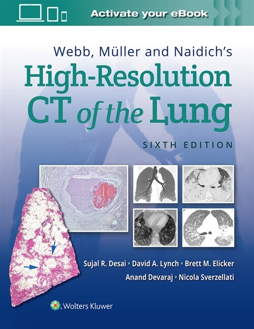 Webb, Muller and Naidichs High-Resolution CT of the Lung (Hardcover, 6)