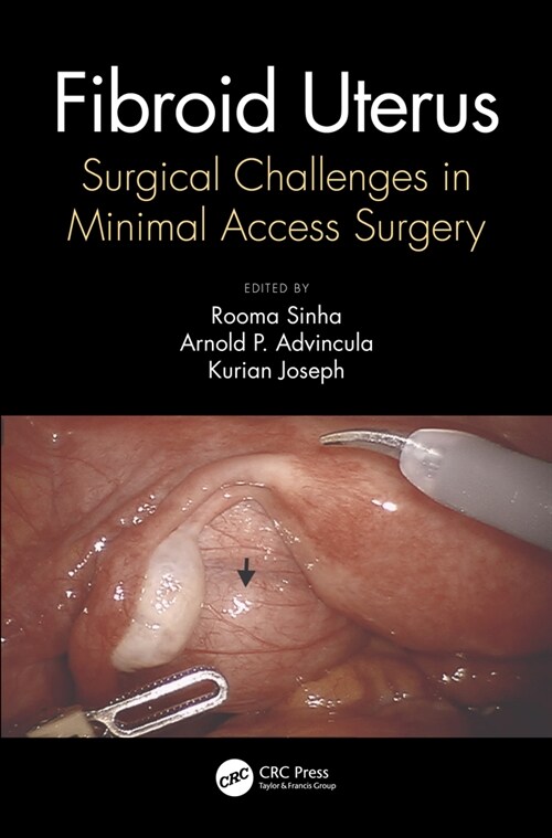 Fibroid Uterus : Surgical Challenges in Minimal Access Surgery (Hardcover)