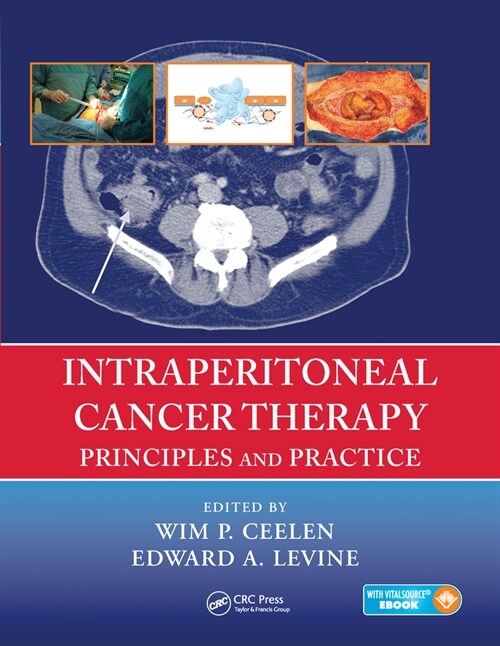 Intraperitoneal Cancer Therapy : Principles and Practice (Paperback)
