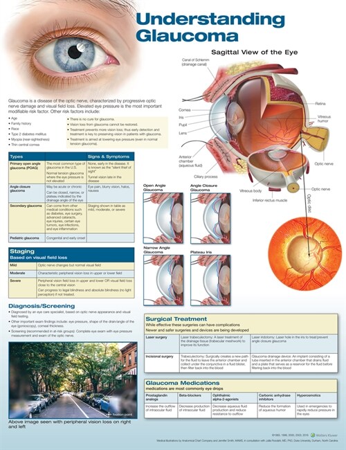 Understanding Glaucoma (Wallchart, 2nd)
