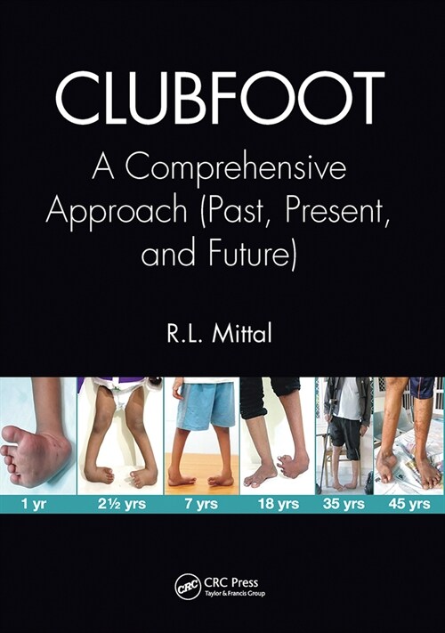 Clubfoot : A Comprehensive Approach (Past, Present, and Future) (Paperback)