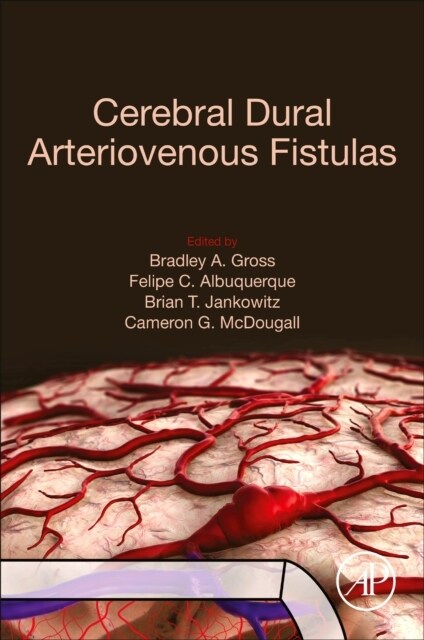 Cerebral Dural Arteriovenous Fistulas (Paperback)