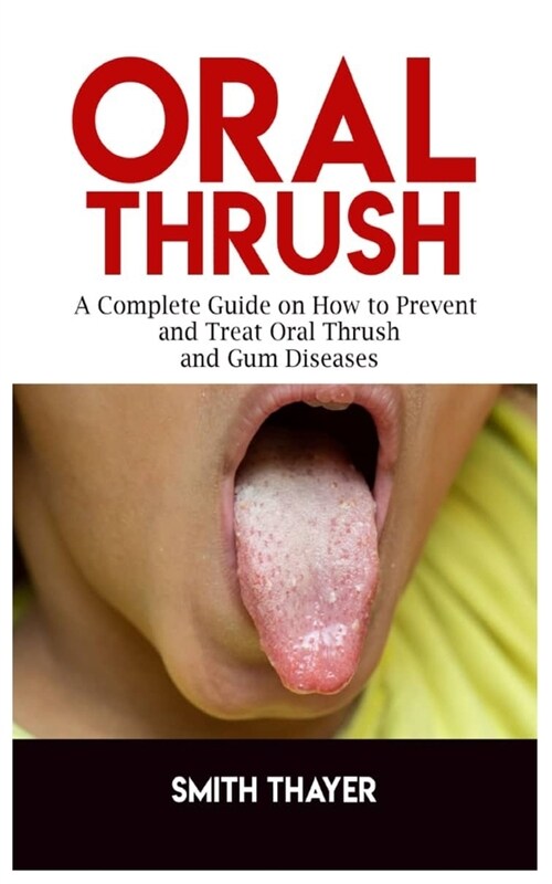 Oral Thrush: A Complete Guide on How to Prevent and Treat Oral Thrush and Gum Diseases (Paperback)