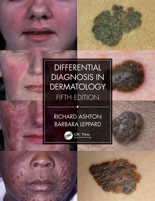 Differential Diagnosis in Dermatology (Paperback, 5 ed)