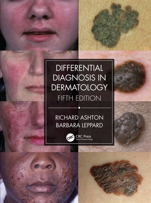 Differential Diagnosis in Dermatology (Hardcover, 5 ed)
