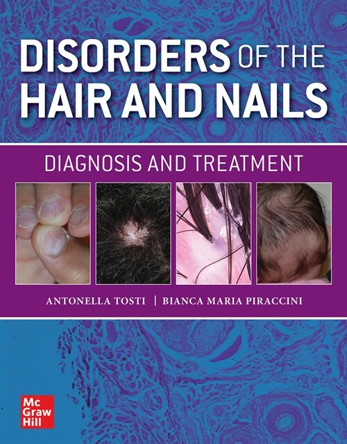 Disorders of the Hair and Nail: Diagnosis and Treatment (Hardcover)