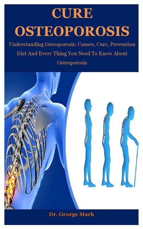 Cure Osteoporosis: Understanding Osteoporosis: Causes, Cure, Prevention Diet And Every Thing You Need To Know About Osteoporosis (Paperback)