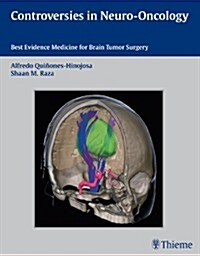 Controversies in Neuro-Oncology: Best Evidence Medicine for Brain Tumor Surgery (Hardcover)