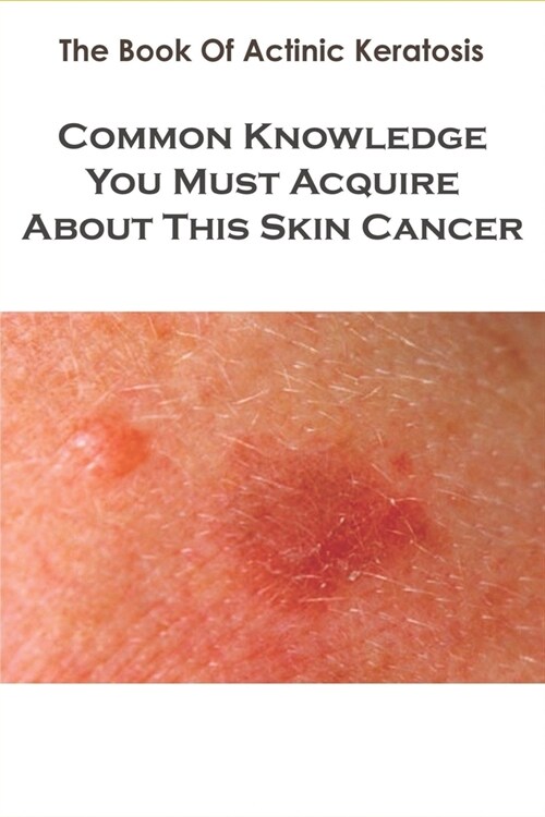 The Book Of Actinic Keratosis_ Common Knowledge You Must Acquire About This Skin Cancer: Skin Cancer Natural Treatment Book (Paperback)