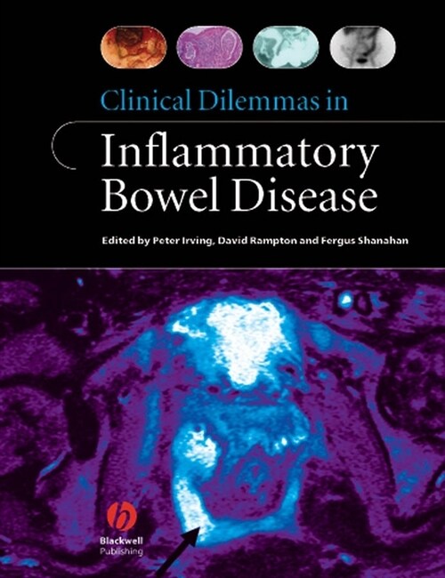 [eBook Code] Clinical Dilemmas in Inflammatory Bowel Disease (eBook Code, 1st)