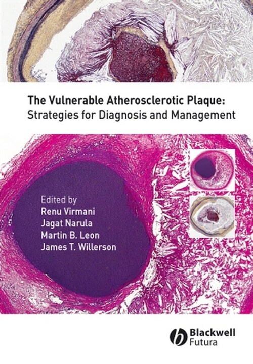 [eBook Code] The Vulnerable Atherosclerotic Plaque (eBook Code, 1st)