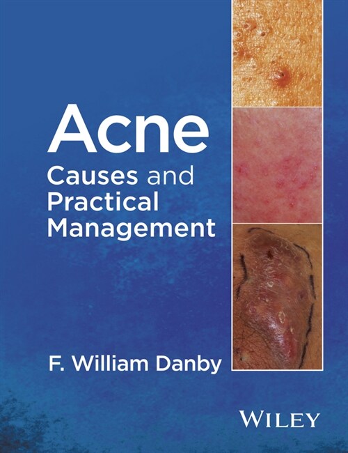 [eBook Code] Acne (eBook Code, 1st)