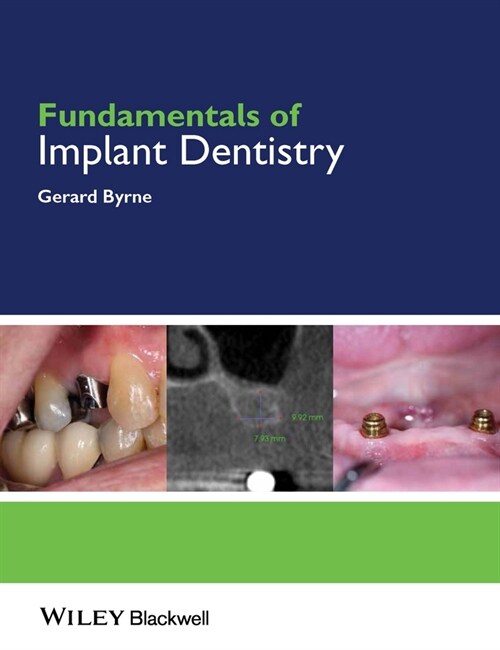 [eBook Code] Fundamentals of Implant Dentistry (eBook Code, 1st)