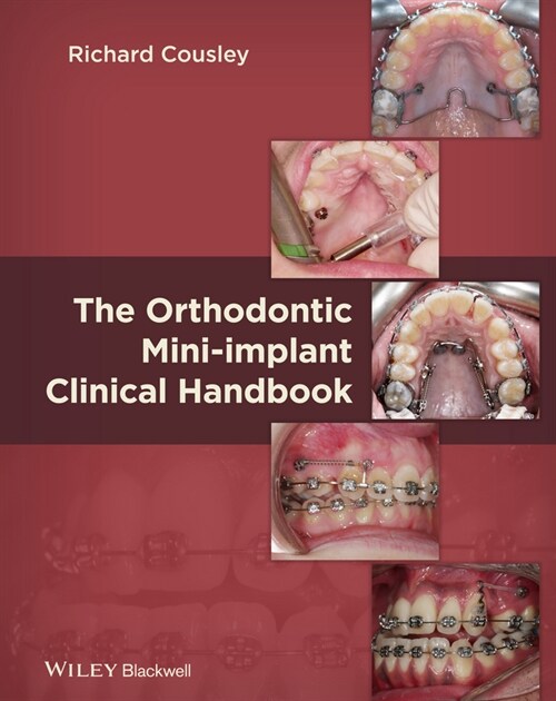 [eBook Code] The Orthodontic Mini-implant Clinical Handbook (eBook Code, 1st)