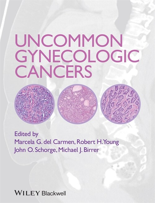 [eBook Code] Uncommon Gynecologic Cancers (eBook Code, 1st)
