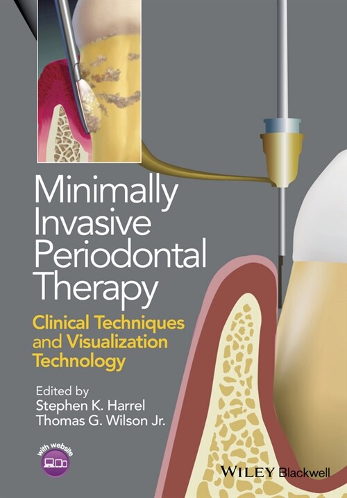 [eBook Code] Minimally Invasive Periodontal Therapy (eBook Code, 1st)
