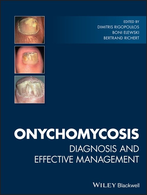 [eBook Code] Onychomycosis (eBook Code, 1st)
