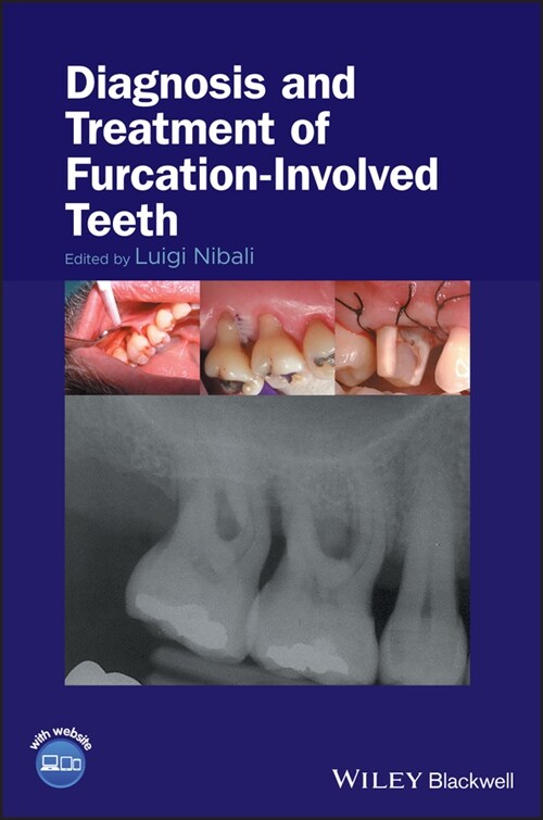 [eBook Code] Diagnosis and Treatment of Furcation-Involved Teeth (eBook Code, 1st)
