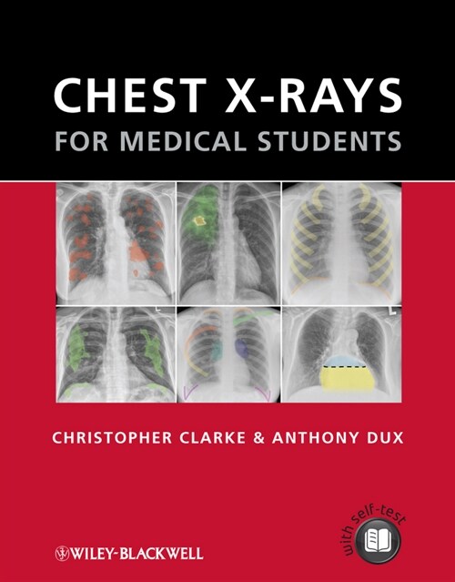 [eBook Code] Chest X-rays for Medical Students (eBook Code, 1st)