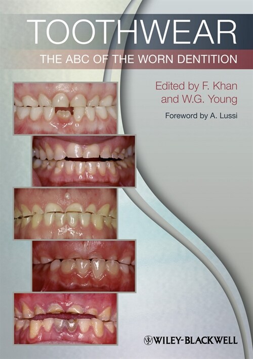 [eBook Code] Toothwear (eBook Code, 1st)