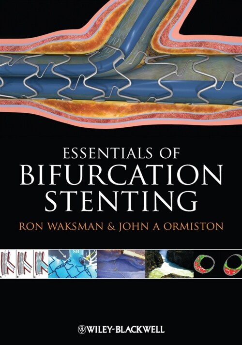 [eBook Code] Bifurcation Stenting (eBook Code, 1st)