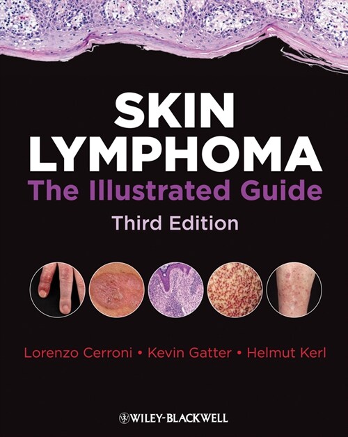 [eBook Code] Skin Lymphoma (eBook Code, 3rd)