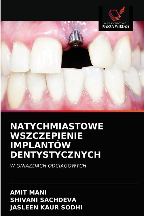 Natychmiastowe Wszczepienie Implant? Dentystycznych (Paperback)