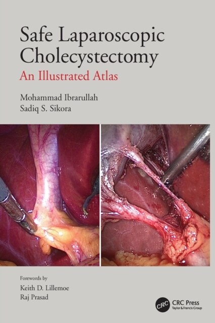 Safe Laparoscopic Cholecystectomy : An Illustrated Atlas (Paperback)