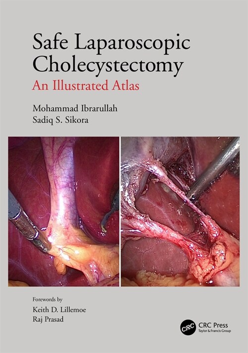Safe Laparoscopic Cholecystectomy : An Illustrated Atlas (Hardcover)