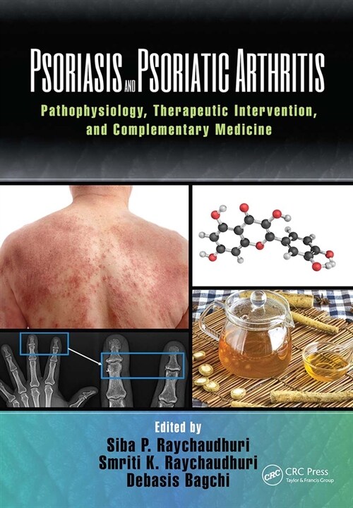 Psoriasis and Psoriatic Arthritis : Pathophysiology, Therapeutic Intervention, and Complementary Medicine (Paperback)