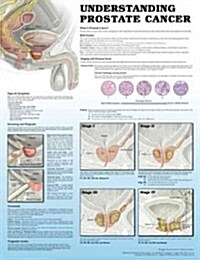 Understanding Prostate Cancer, Laminated Chart (Chart, 2nd)