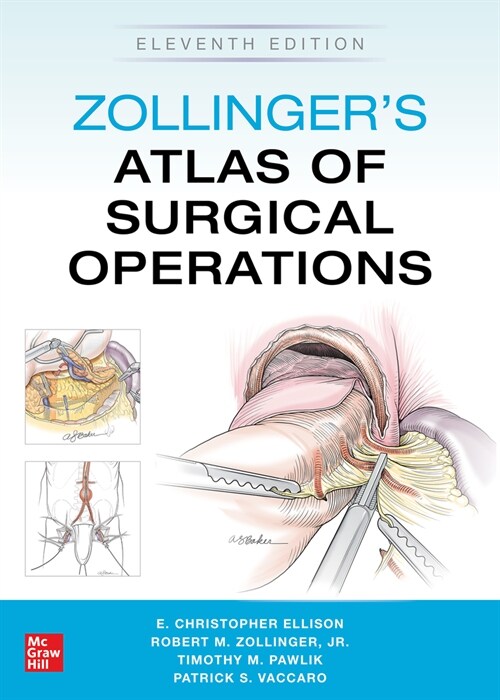 Zollingers Atlas of Surgical Operations, Eleventh Edition (Hardcover, 11)