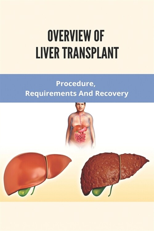 Overview Of Liver Transplant: Procedure, Requirements, And Recovery: Types Of Liver Transplant (Paperback)