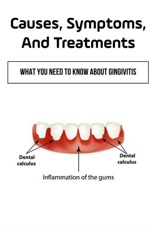 Causes, Symptoms, And Treatments: What You Need To Know About Gingivitis: What Is Gingivitis (Paperback)