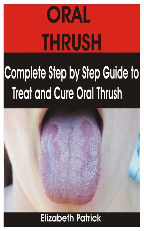 Oral Thrush: Complete Step by Step Guide to Treat and Cure Oral Thrush (Paperback)