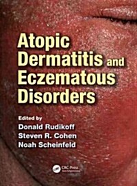 Atopic Dermatitis and Eczematous Disorders (Hardcover)