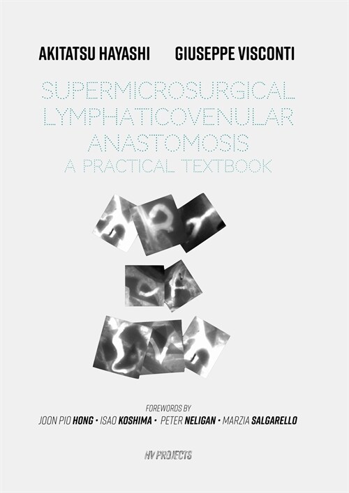 Supermicrosurgical LymphaticoVenular Anastomosis: A Practical Textbook.: LVA Textbook (Paperback)