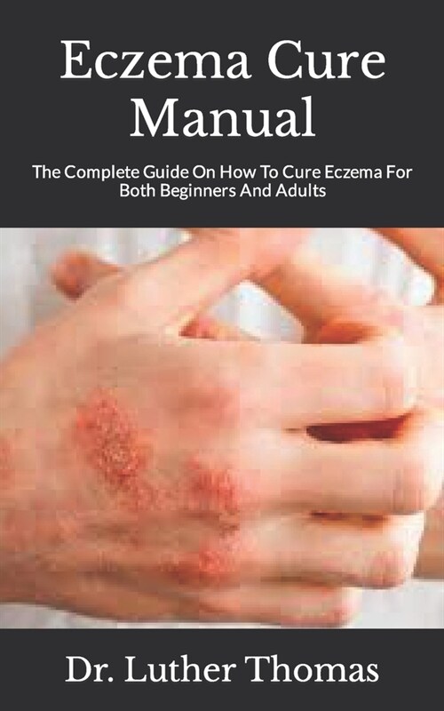 Eczema Cure Manual: The Complete Guide On How To Cure Eczema For Both Beginners And Adults (Paperback)