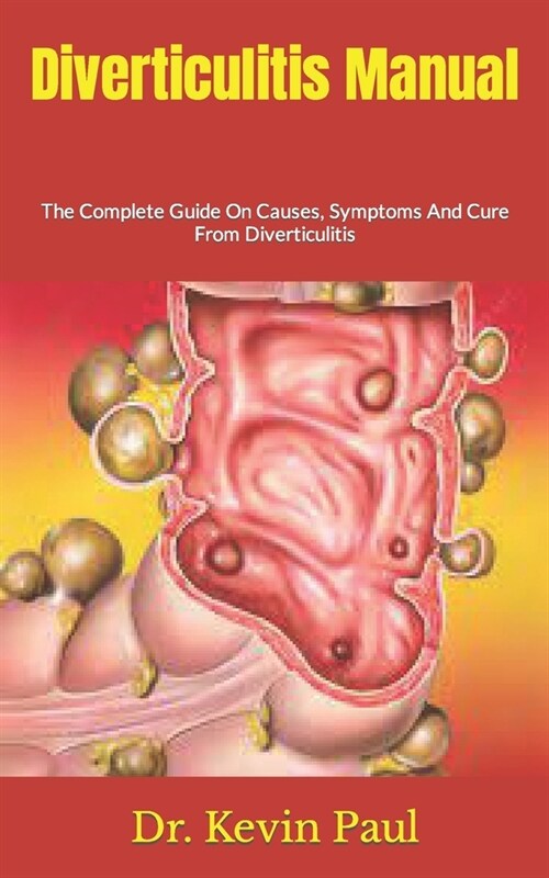 Diverticulitis Manual: The Complete Guide On Causes, Symptoms And Cure From Diverticulitis (Paperback)